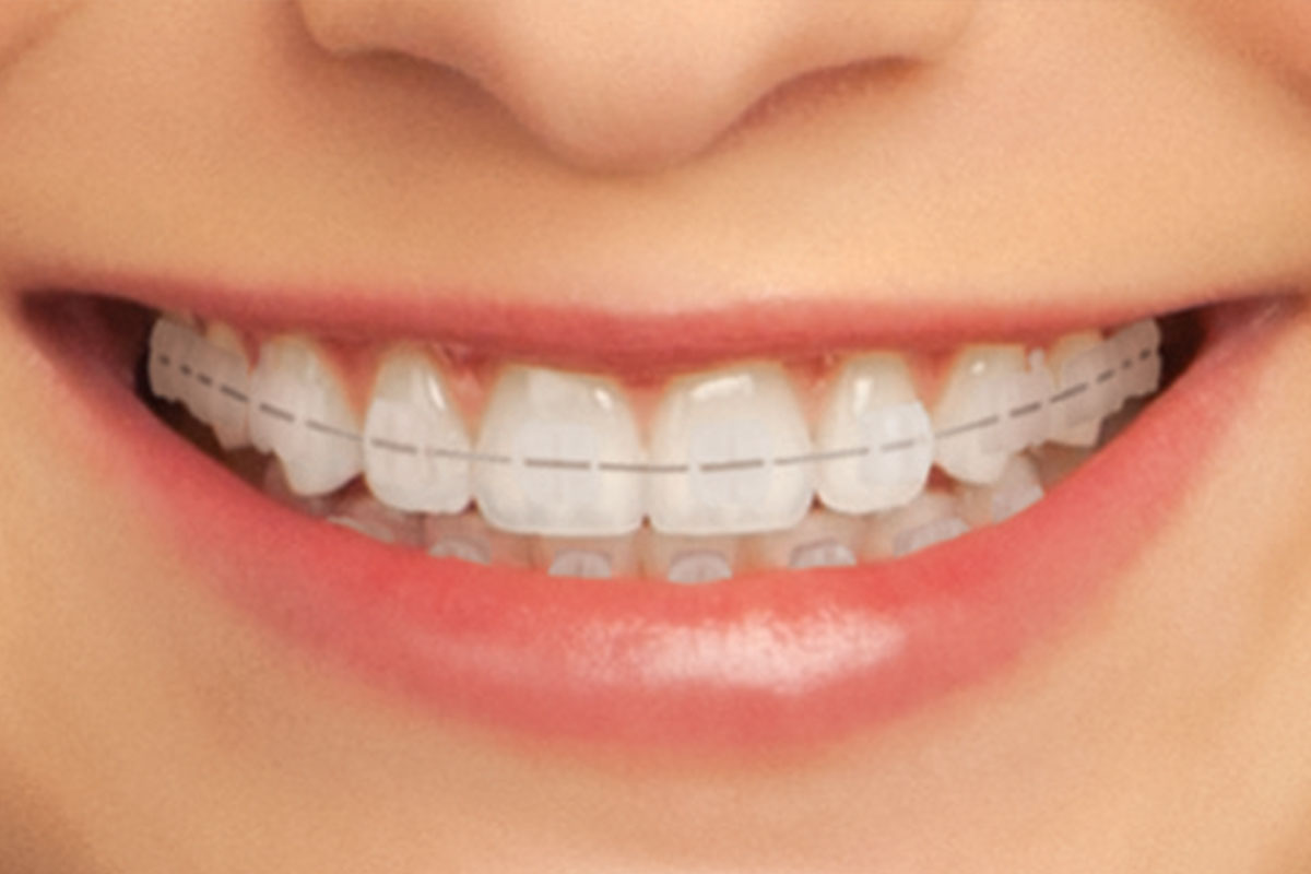 clear-braces-teeth-braces-clinic-indore