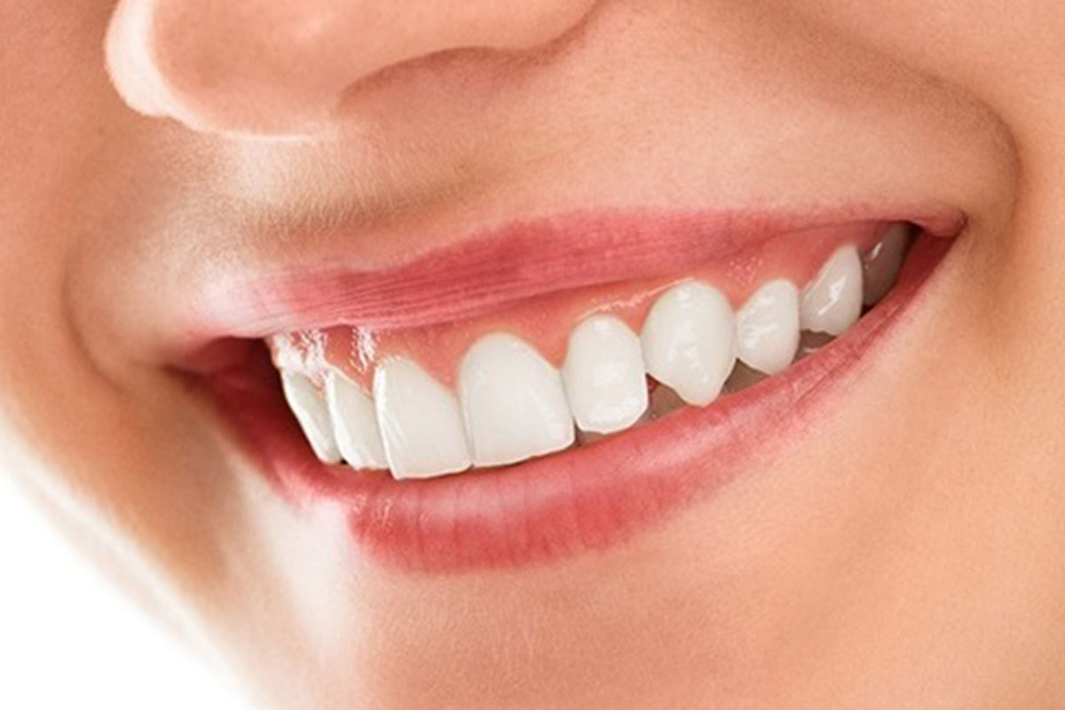 Smile Makeover Treatment Teeth And Braces Clinic Indore 