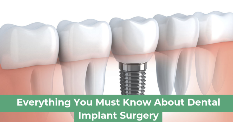 Everything You Must Know About Dental Implant Surgery