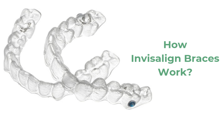 How Invisalign Braces Work