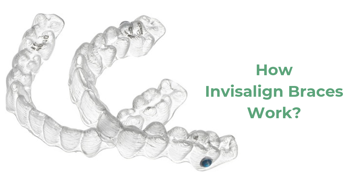 Invisible Braces Indore, Invisalign braces